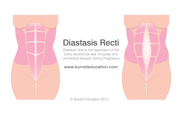 Front view of patient's abdominal taping (rectus abdominus and