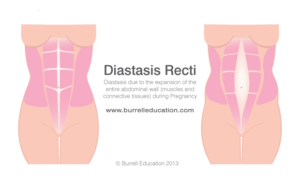 Diastasis-Recti-1